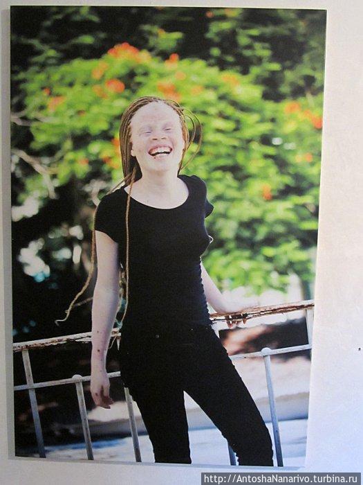 Фотография девушки-альбиноса на фотовыставке в Форте Мапуту. Мозамбик Фотография девушки-альбиноса на фотовыставке в Форте Мапуту. Мозамбик