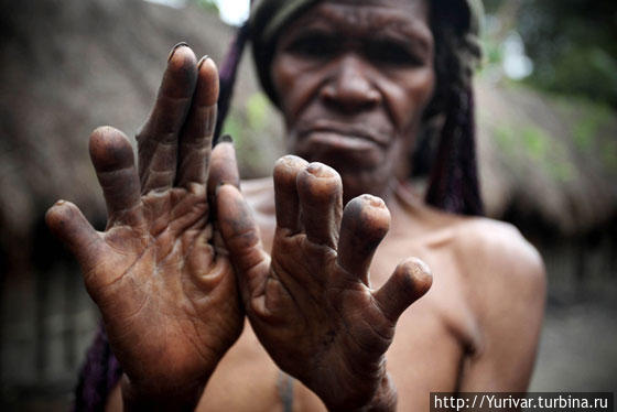 Отрубленные пальцы — знак скорби по умершим близким родственникам. Фото из интернета Вамена, Индонезия